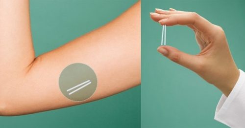 ANTICONCEPCION HORMONAL CON ENFASIS EN IMPLANTE SUBDERMICO